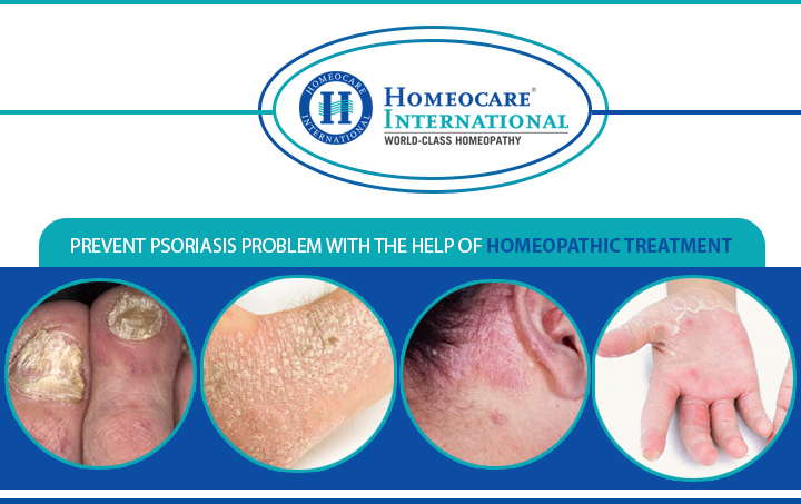 Treatment-for-Psoriasis