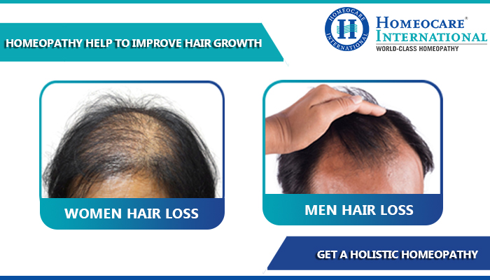 Looking for best hair loss treatment? Approach Homeocare International  specialists - Homeocare International