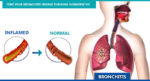 Permanent cure for bronchitis disease at Homeocare International