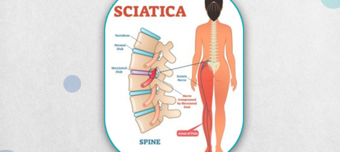 Sciatica Disease can be cured permanently at Homeocare International