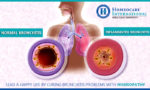 Symptoms of bronchitis can be cured effectively at Homeocare International