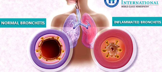 Symptoms of bronchitis can be cured effectively at Homeocare International