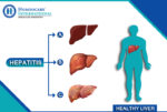 For best Hepatitis Treatment approach Homeocare International specialists
