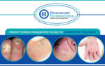 Get Best Treatment for Psoriasis at Homeocare International