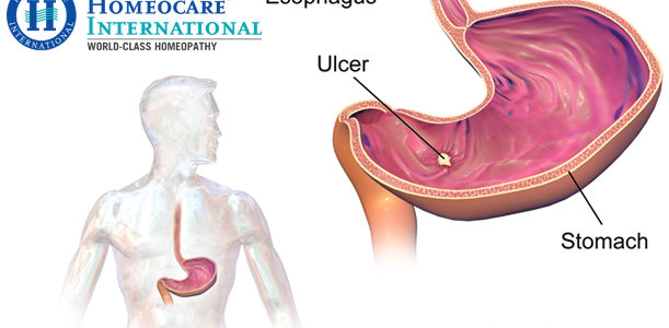 Relieve Your Ulcer Symptoms by Undergoing Homeopathy Treatment at Homeocare International