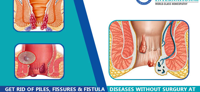 Get rid of piles, fissures & fistula diseases without surgery at Homeocare International
