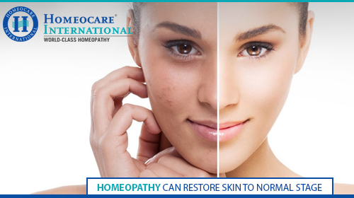 Homeopathy treatment for skin diseases
