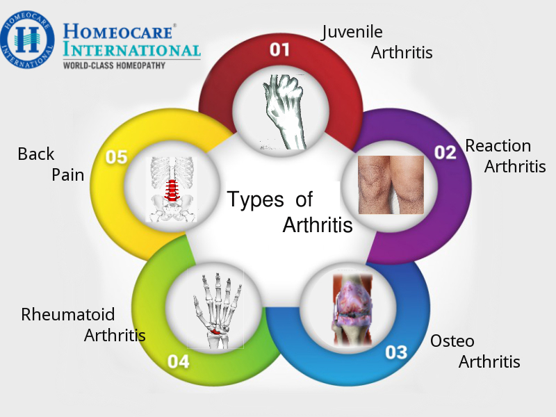 Arthritis homeopathic treatment.1