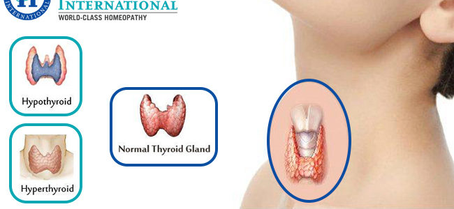 Thyroid Gland and Its is disorders. How to overcome with Homeopathy?
