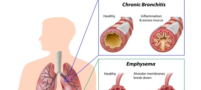 Homeopathy Treatment for Bronchitis