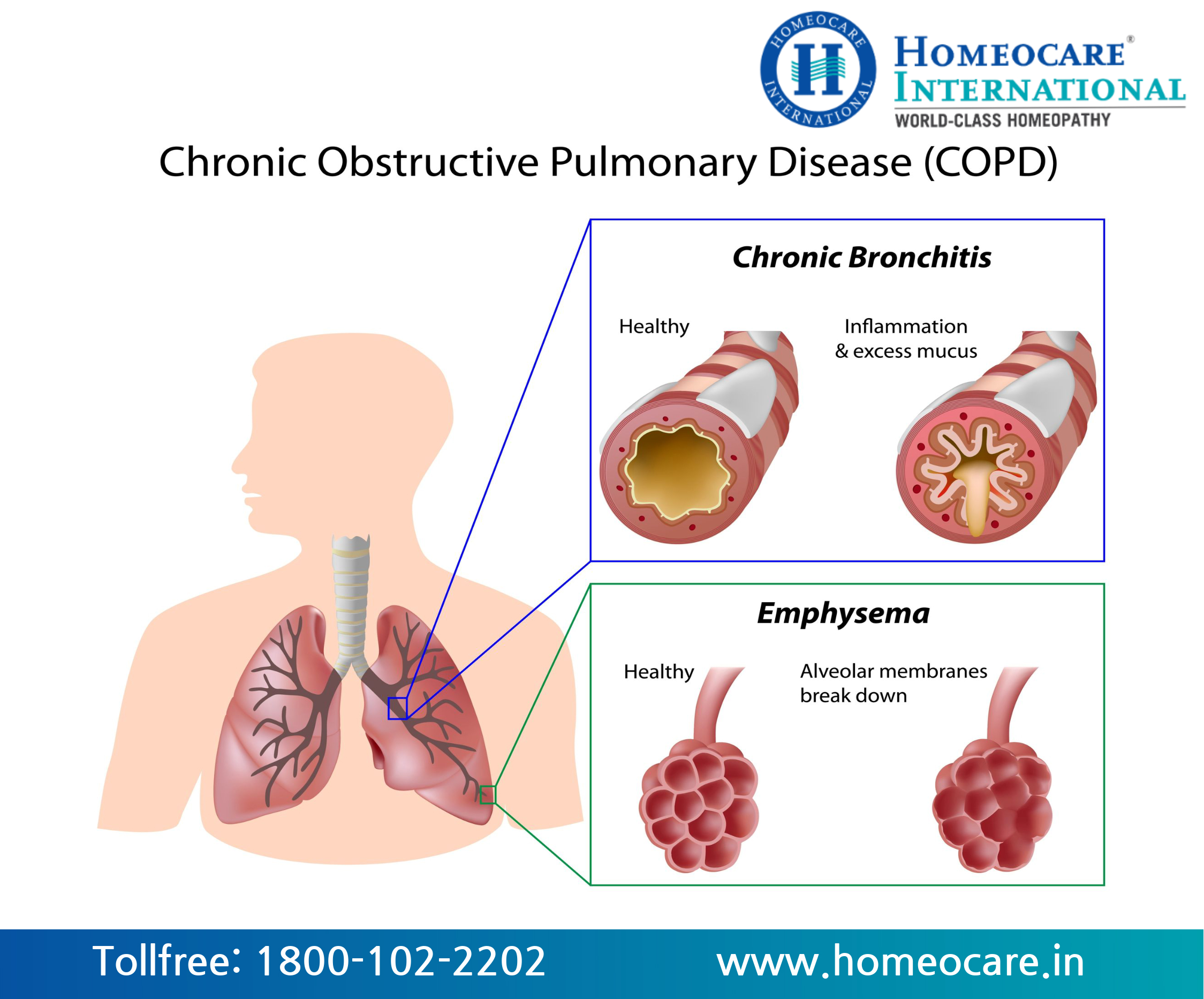 Homeopathy Treatment for Bronchitis 