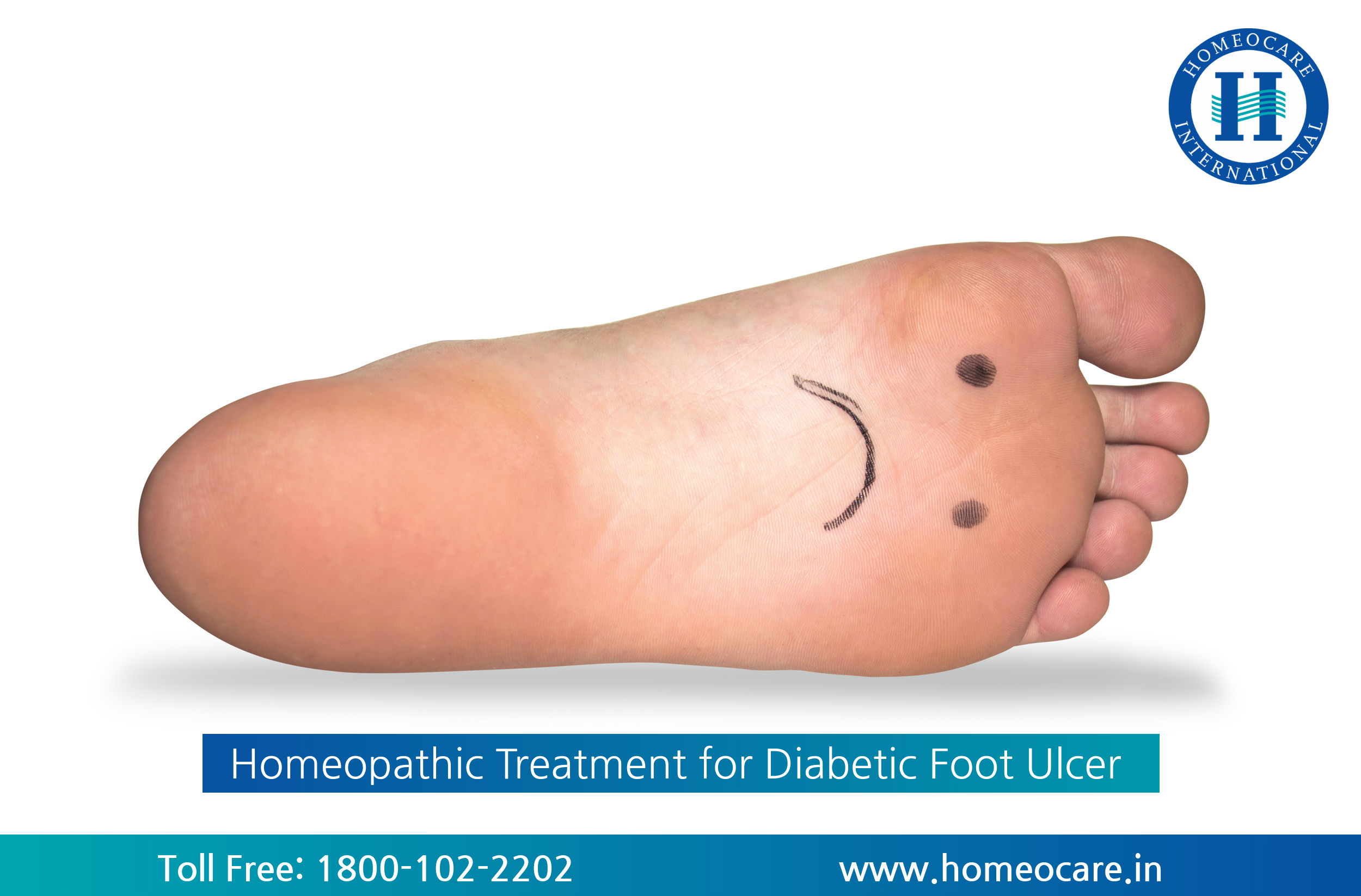 Homeopathy Treatment for Diabetic Foot Ulcer