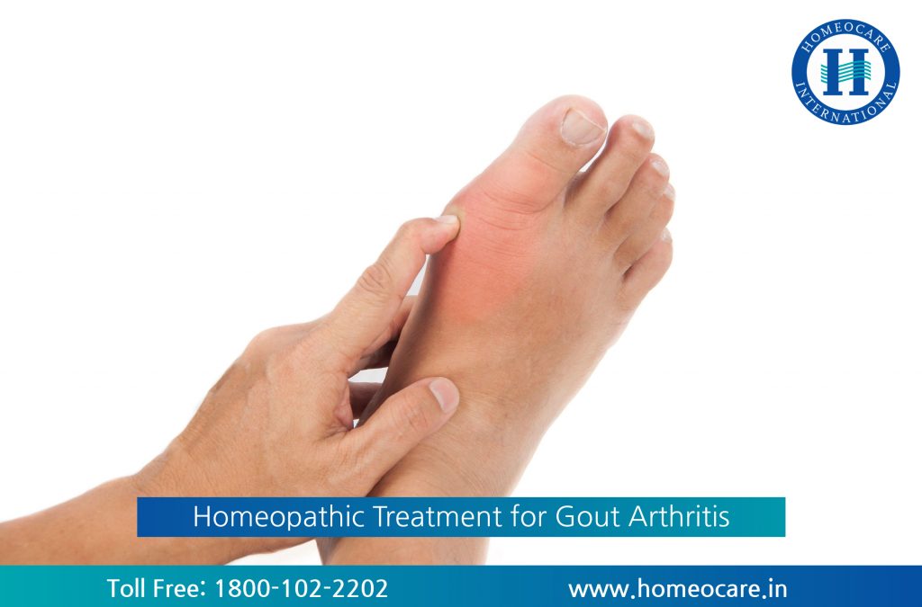 Gout Arthritis Treatment at Homeocare International