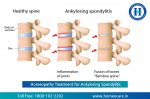 Ankylosing Spondylitis Treatment at Homeocare International