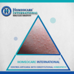 Control Urticaria with Constitutional Homeo @ Homeocare International