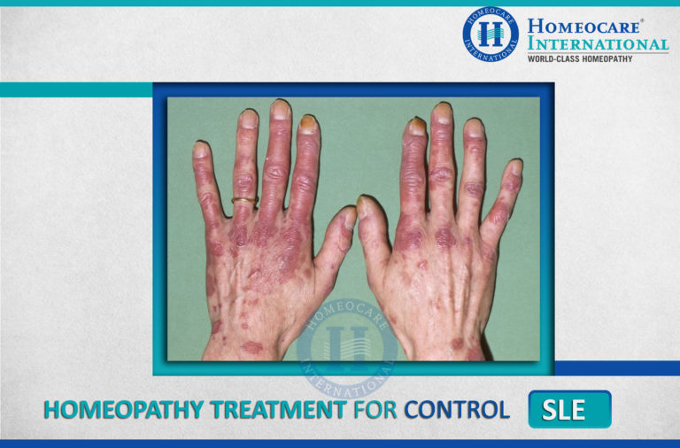 Control SLE Systemic Lupus Erythematosus Successfully With 