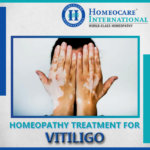Control those white patches of Vitiligo with Constitutional Homeopathy
