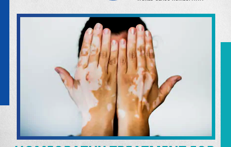 Control those white patches of Vitiligo with Constitutional Homeopathy