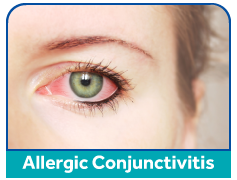 allergic-conjunctivitis
