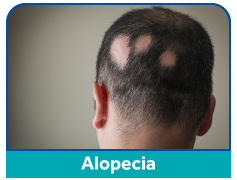 alopeica