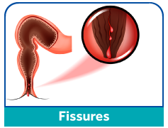 fissures