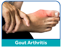 gout-arthritis