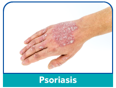 psoriasis