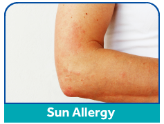 sun-allergy